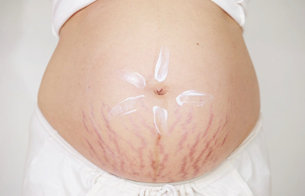 Prescar Cream, Prevents skin injury due to natural stretching during pregnancy.